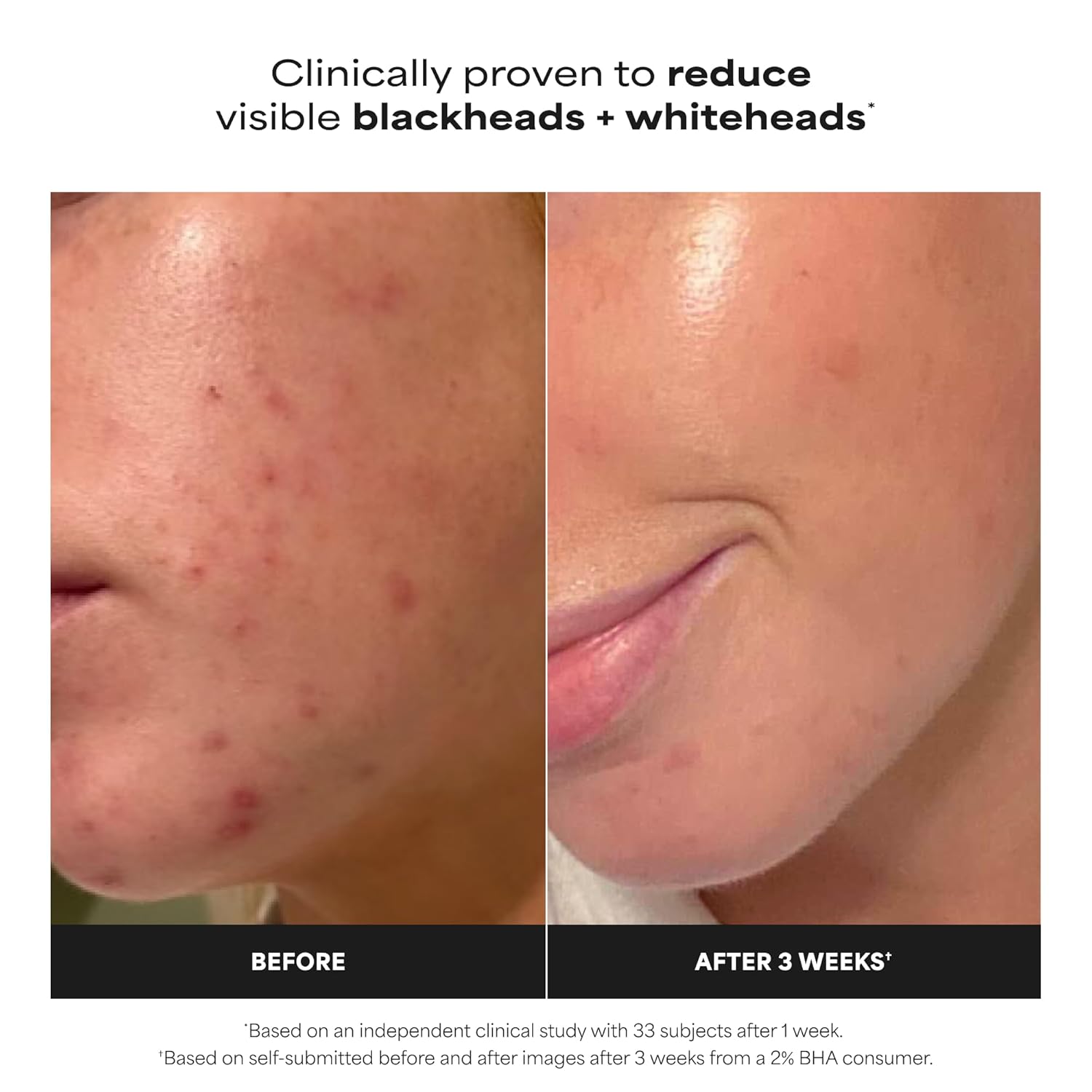 Paula's Choice SKIN PERFECTING 2% BHA Liquid Exfoliant with Salicylic Acid