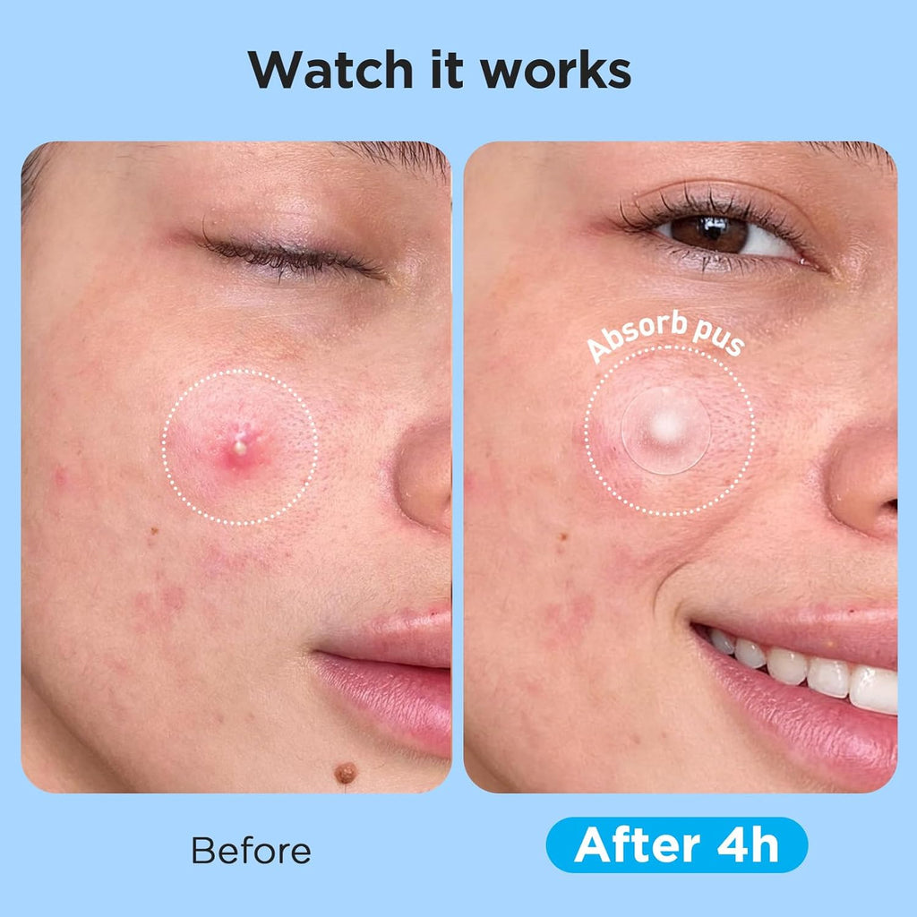 Pimple Patches for Face (504 Count), FSA Eligible Acne Patch Bulk, Zit