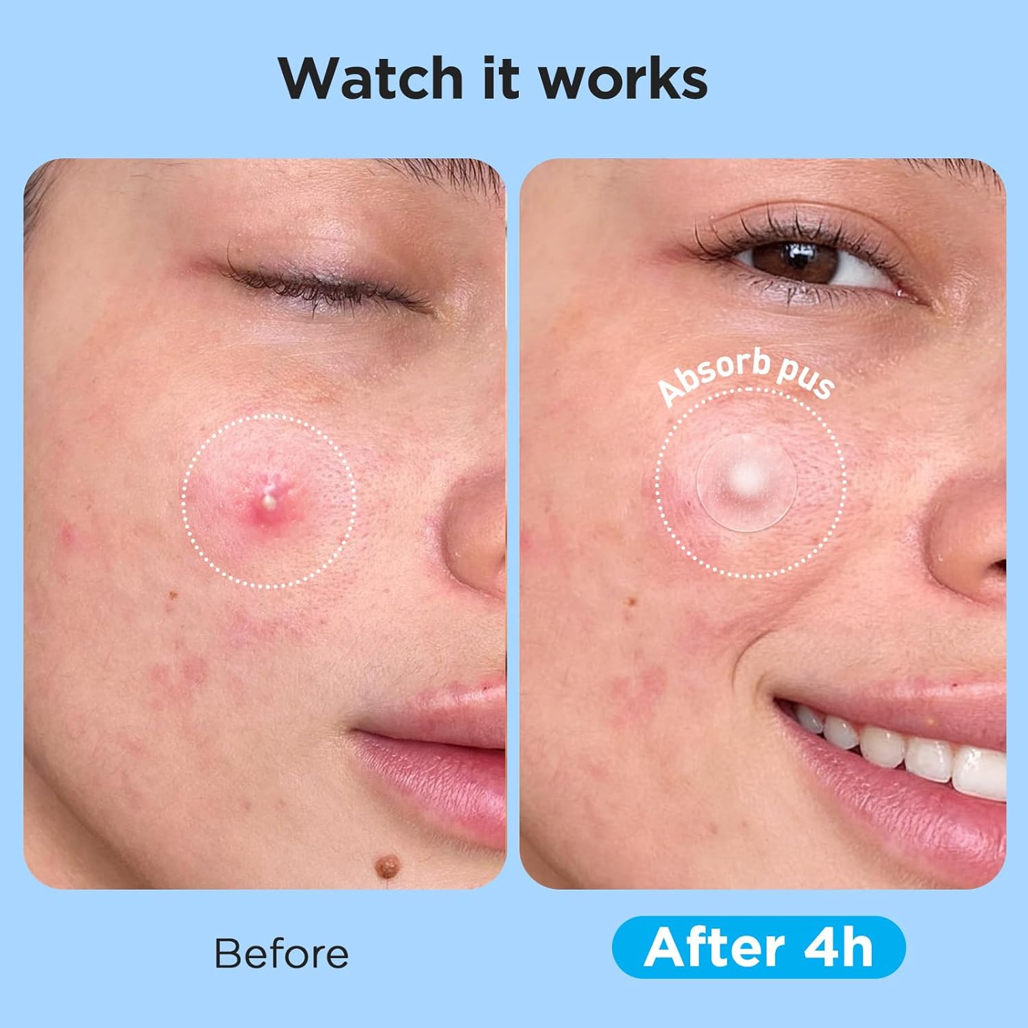 Pimple Patches for Face (504 Count), FSA Eligible Acne Patch Bulk, Zit