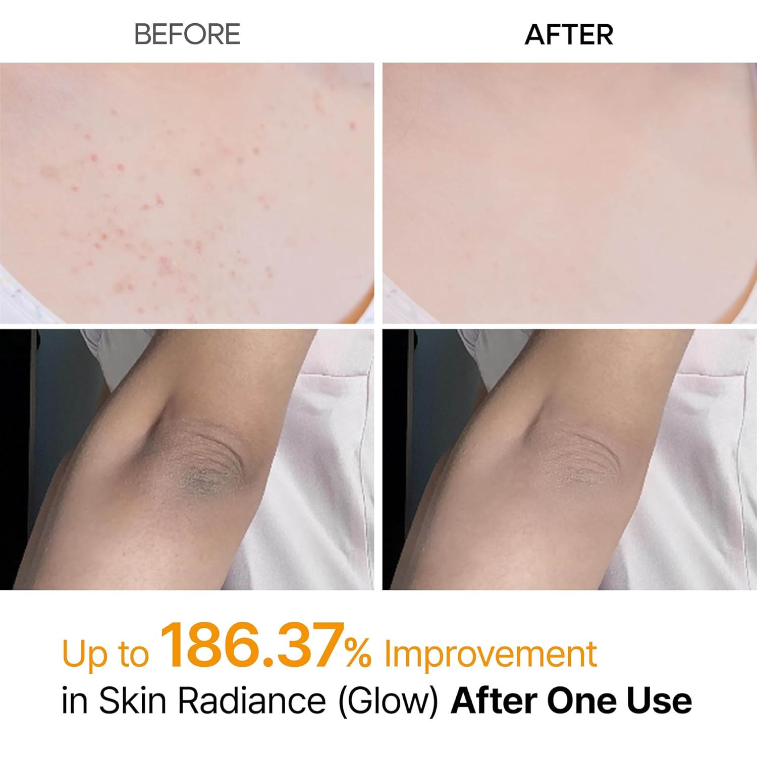 Dr.Melaxin Body Keratin Care Kojic Acid Turmeric Spray with AHA & PHA, Gentle