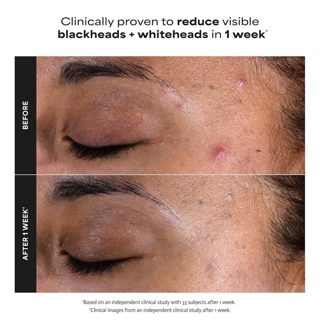 Paula's Choice SKIN PERFECTING 2% BHA Liquid Exfoliant with Salicylic Acid