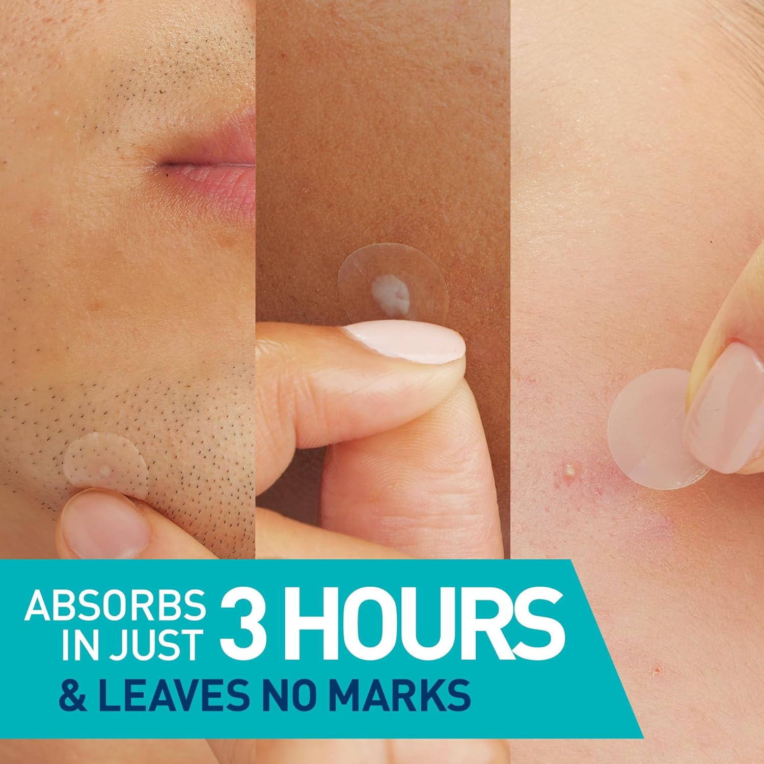 CeraVe Hydrocolloid Blemish Patches, Oil Absorbing Spot Control with